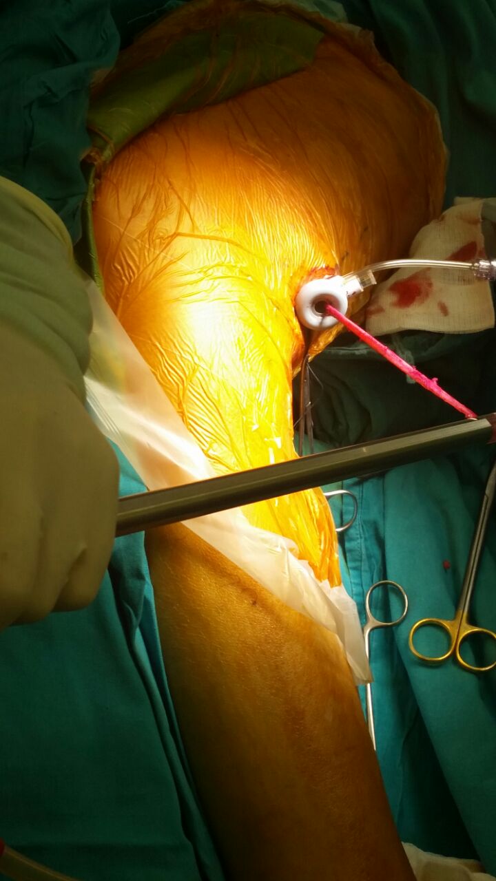 b-endoskopik-olarak-cikarilan-toplardamar-ameliyat-goruntusu
